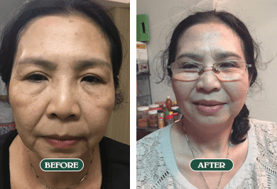 Ảnh căng da bằng chỉ Đà Nẵng