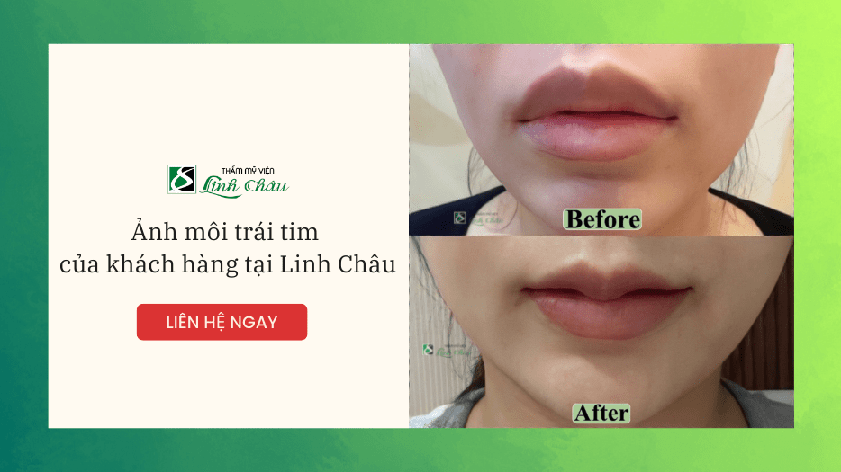 Hình Ảnh Môi Trái Tim Của Khách Hàng Thực Hiện Tại Linh Châu Đà Nẵng