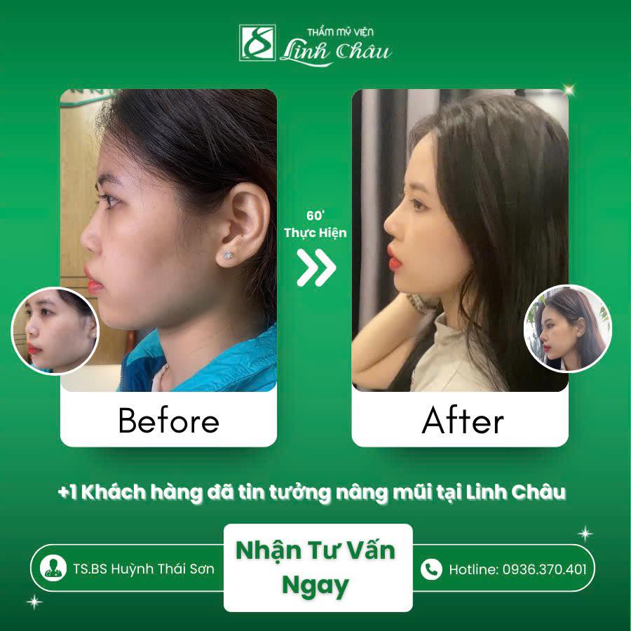 Khách hàng tự tin sau khi nâng mũi tại TMV Linh Châu