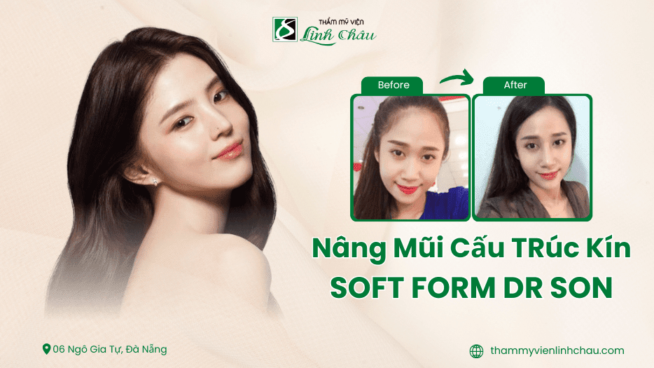 Nâng Mũi Cấu Trúc Kín - TMV Linh Châu