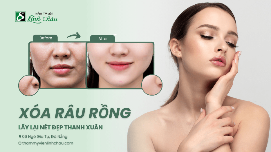 Xóa Râu Rồng Rãnh Cười Mũi Má - TMV Linh Châu