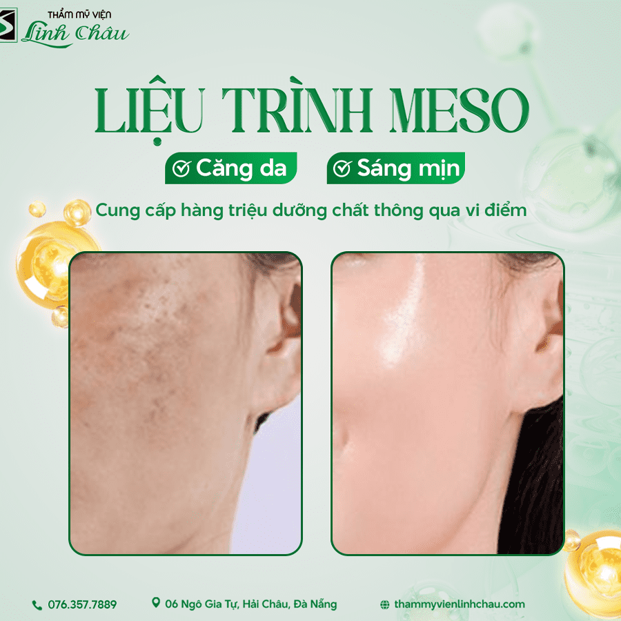 Meso therapy – Tiêm vi điểm nuôi da tầng sâu
