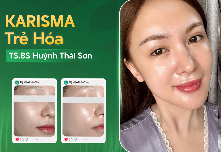 Trẻ hóa da mặt cấp ẩm – tái cấu trúc bằng Karisma RH Collagen