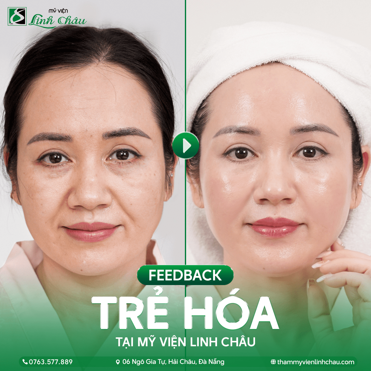 GIẢI PHÁP TRẺ HÓA DA TOÀN DIỆN TẠI TMV LINH CHÂU