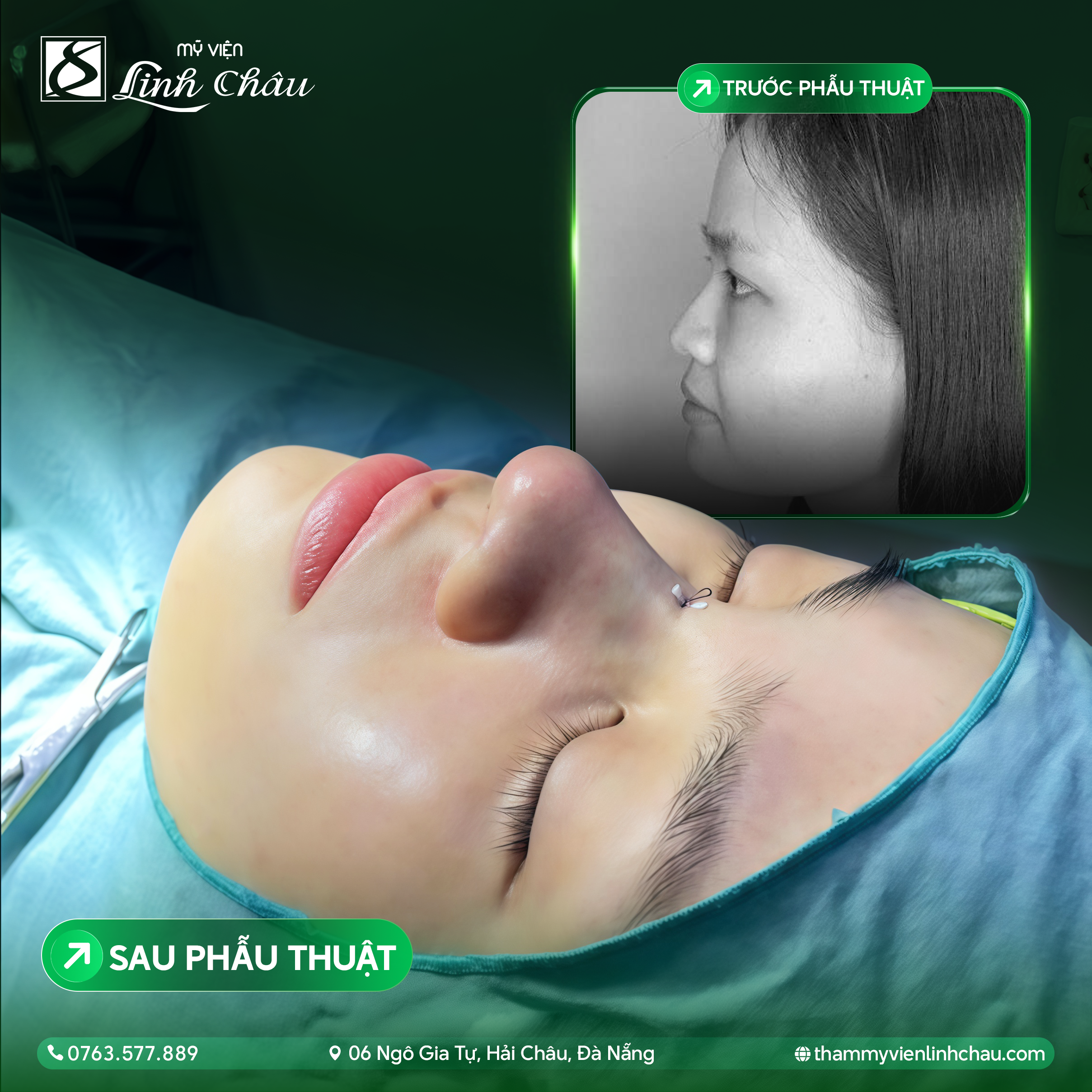 Nâng mũi không phẫu thuật công nghệ cao - Xu hướng mới