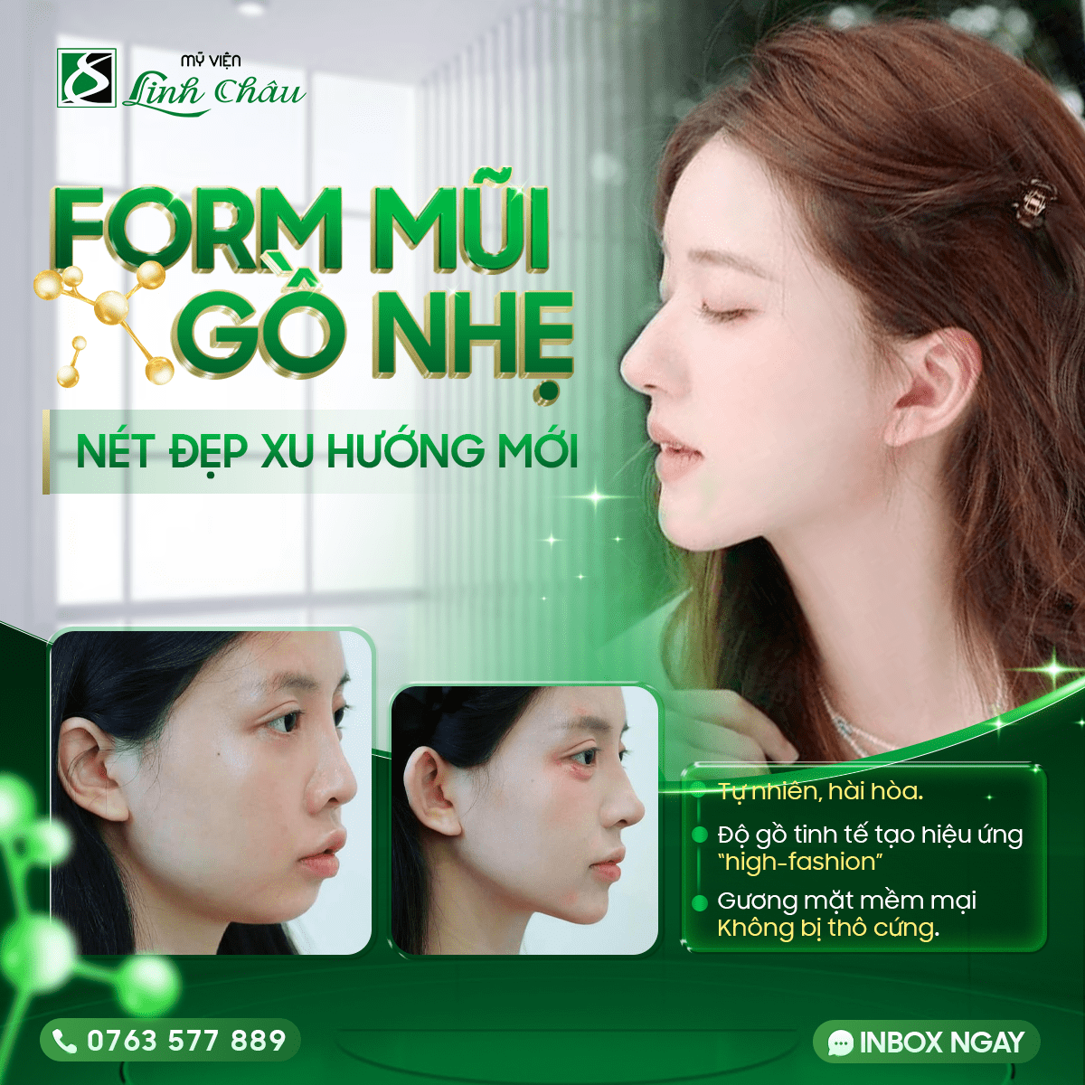 Các dáng mũi nâng tự nhiên 2026 – Xu hướng thẩm mỹ an toàn, hài hòa khuôn mặt