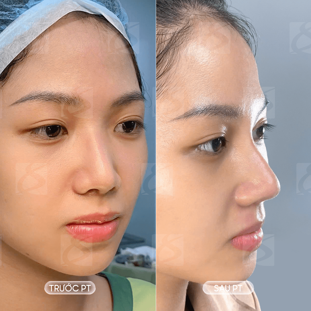 5. Mũi nhỏ lại tự nhiên sụn mũi Surgiform khác gì so với các phương pháp khác?