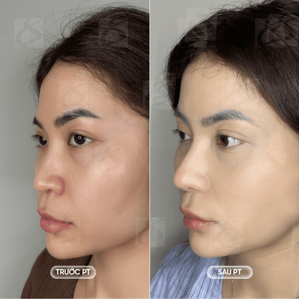 Nâng mũi cao tự nhiên - Giải pháp kiến tạo dáng mũi hài hòa, an toàn chuẩn y khoa