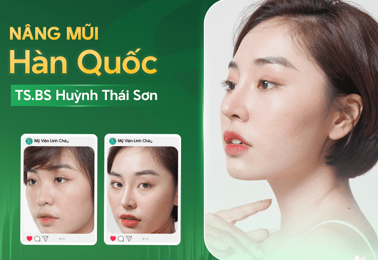 Nâng mũi cao tự nhiên - Giải pháp kiến tạo dáng mũi hài hòa, an toàn chuẩn y khoa